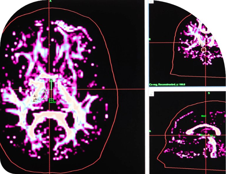 Hydrocephalus Macquarie Neurosurgery & Spine