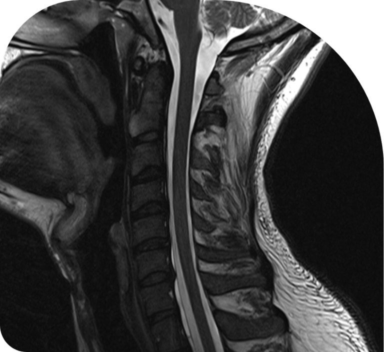 CSF Leak Macquarie Neurosurgery Spine csf-leak-macquarie-neurosurgery-spine