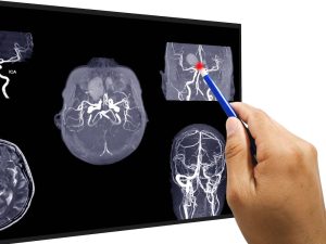 Intracranial aneurysm clipping