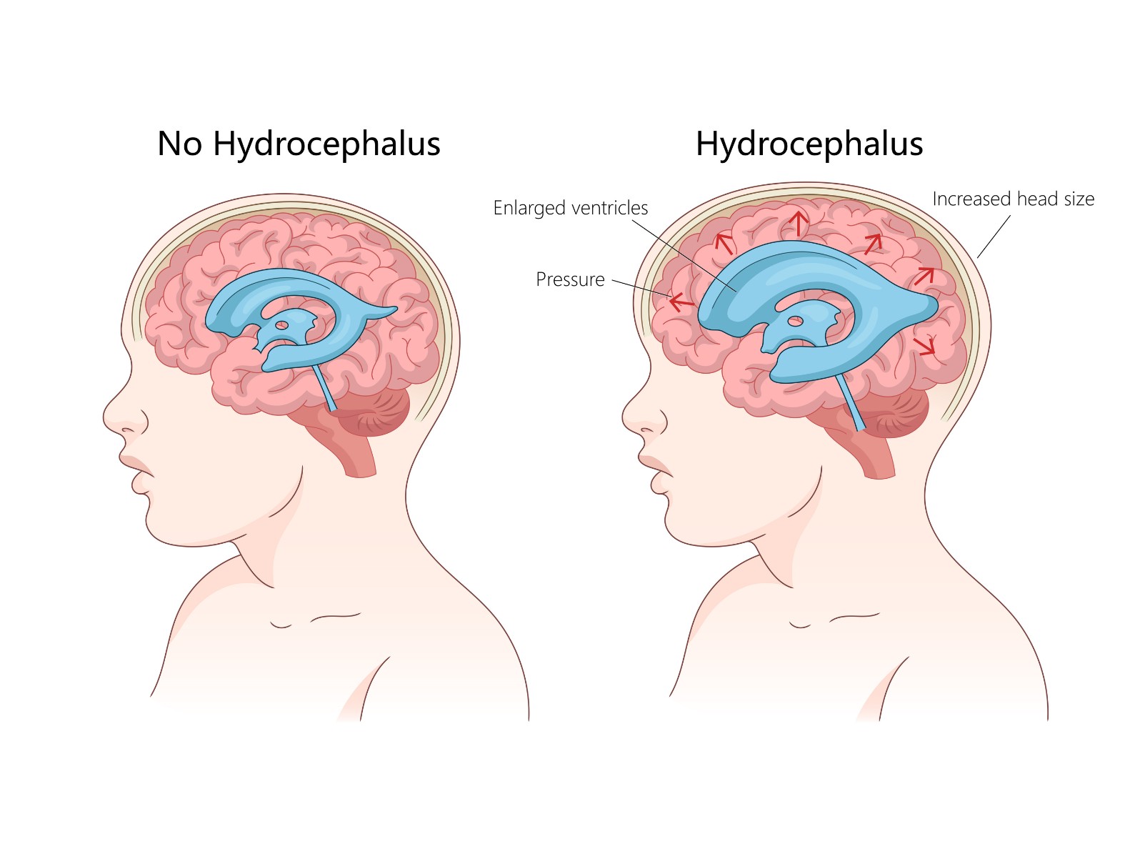 Illustration comparing a child’s brain with and without hydrocephalus, showing enlarged ventricles, increased pressure, and larger head size in hydrocephalus.